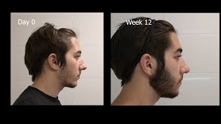 Minoxidil Beard Growth  3 Month Transformation  Timelapse (BEFORE and AFTER)