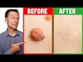 24 時間以内にスキン タグとイボを取り除く方法 - Dr. Berg on Skin Tag Removal