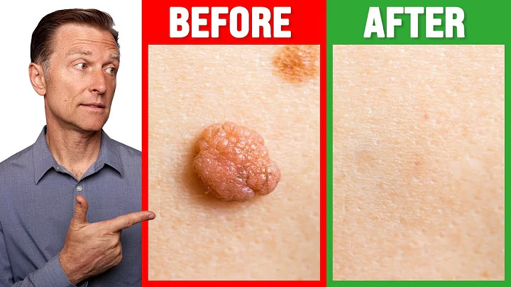 How to Rid Skin Tags and Warts Within 24 Hours - D...