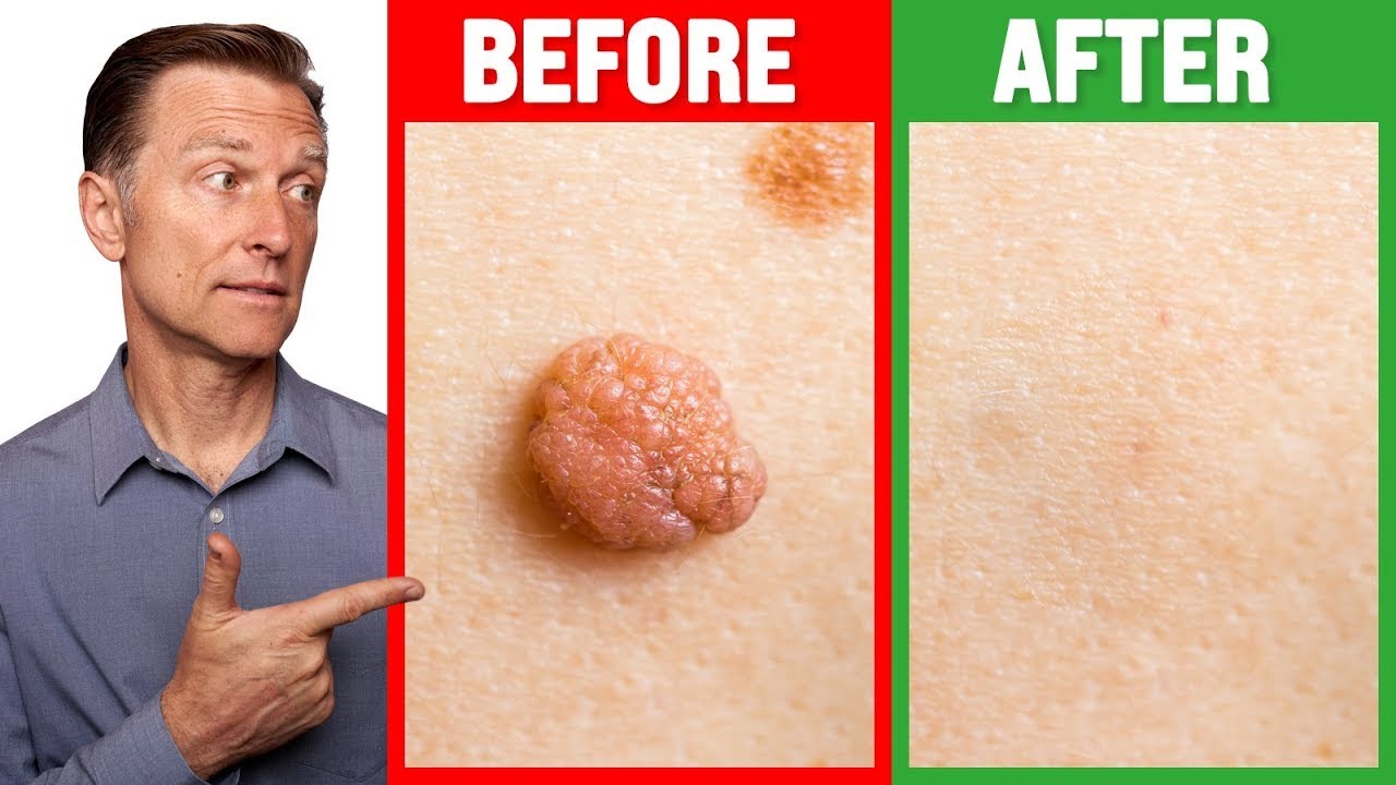 ⁣How to Rid Skin Tags and Warts Within 24 Hours - Dr. Berg on Skin Tag Removal