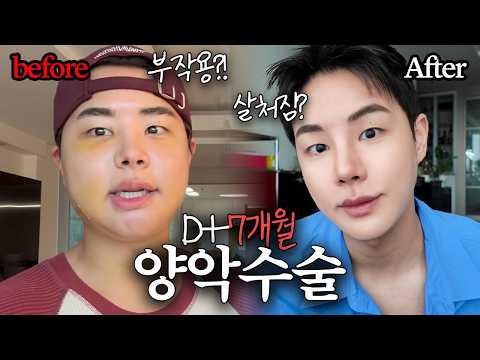 내돈내산‼️양악수술 후 말 못했던 비밀? (양악수술 7개월차 Q&A) thumbnail