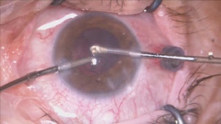 Aqueous miss direction,  cataract in angle closure glaucoma eye Mishev Live Stream