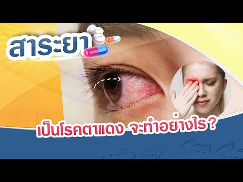 สาระยา | เป็นโรคตาแดง จะทำอย่างไร?