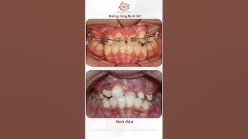 Điều Trị KHỚP CẮN NGƯỢC ( cắn móm ) sẽ như thế nào? #shorts