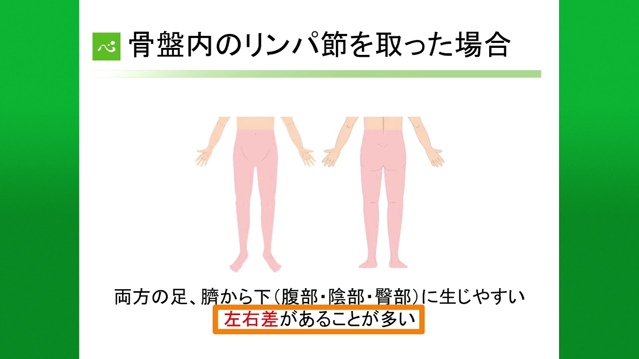 下肢のリンパ浮腫とそのケア   静岡がんセンター