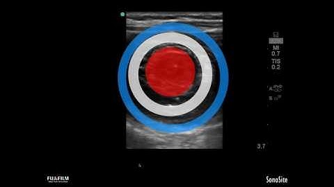 Webinar: Pediatric US Abdominal Imaging - Diagnosing Intussusception, Appendicitis, Pyloric Stenosis