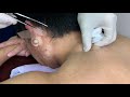 粉瘤くりぬき法 30代男性背中epidermal cyst atheroma cystic acne extractions lipoma大阪心斎橋 大阪梅田院 名古屋 福岡院 神戸西宮 尼崎 奈良
