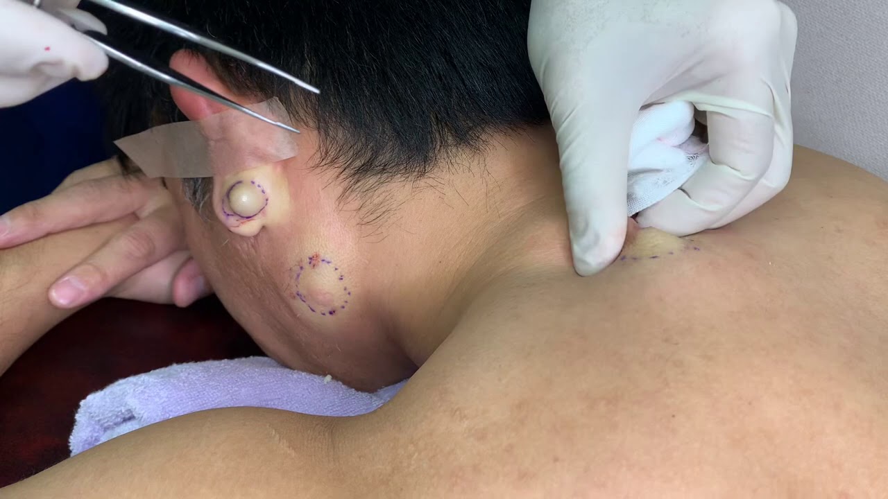 粉瘤くりぬき法 30代男性背中epidermal cyst atheroma cystic acne extractions lipoma大阪心斎橋 大阪梅田院 名古屋 福岡院 神戸西宮 尼崎 奈良