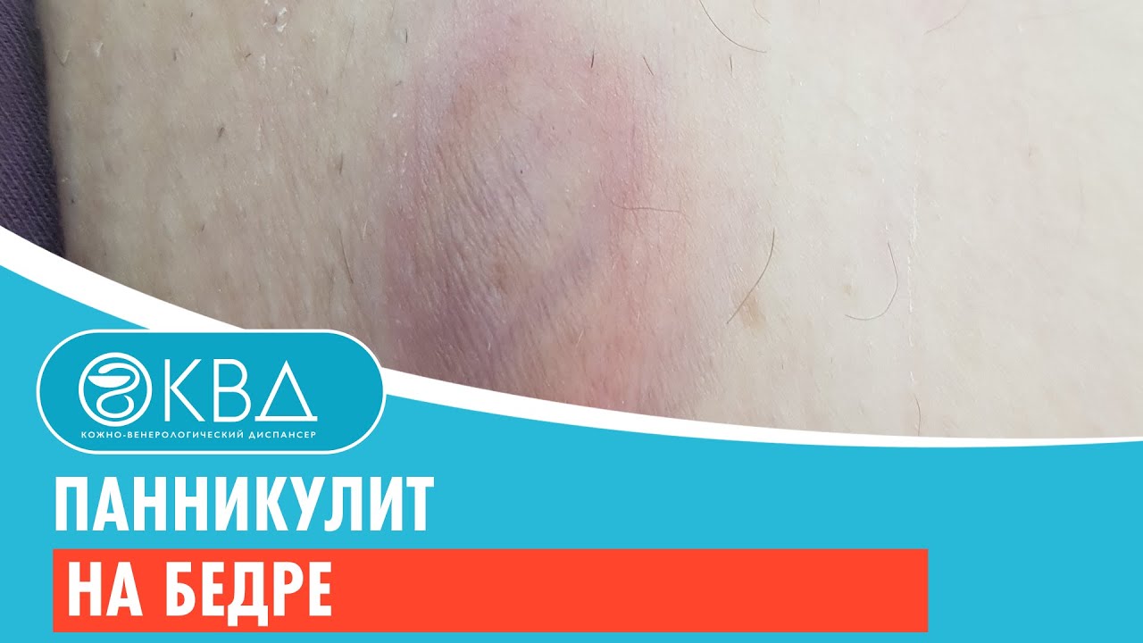 😐 Панникулит на бедре. Клинический случай №256