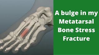A bulge in my Metatarsal Bone Stress Fracture on X ray