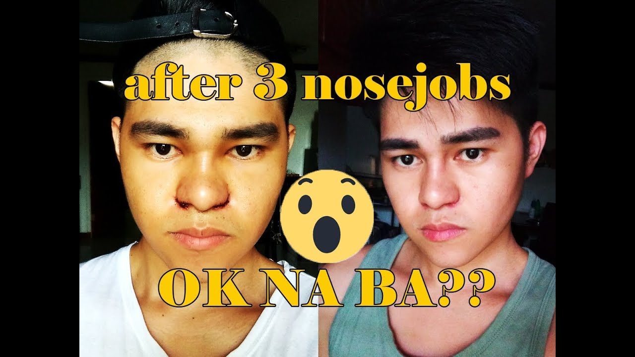 NOSEJOB PHILIPPINES BEFORE AFTER PICTURES REVISED BY DR. JAMES