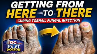 Getting From Here To There Curing Fungal Toenail Infection