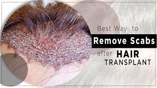 Best Way to Remove Scabs After Hair Transplant | By Dr. Rana Irfan - YouTube