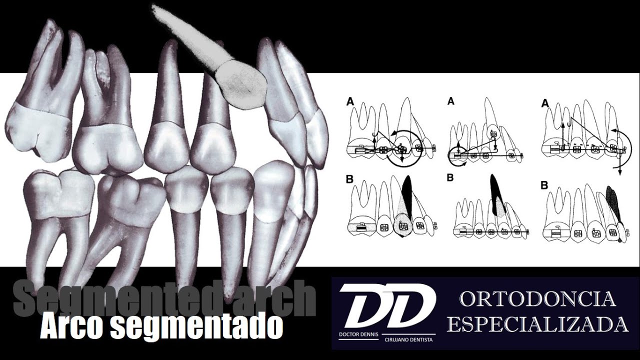 Arco Segmentado: Cantilever