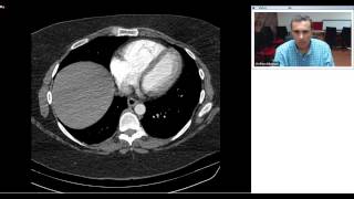 Radiology Teaching On Pulmonary Embolism Dr Ak With Video 1