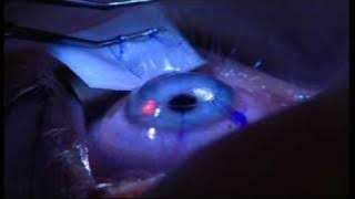 Laser Eye Surgery | The Patient Experience at London Vision Clinic on Harley St. London
