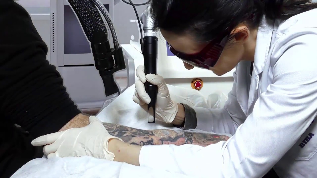 Tattoo Removal Dublin YouTube