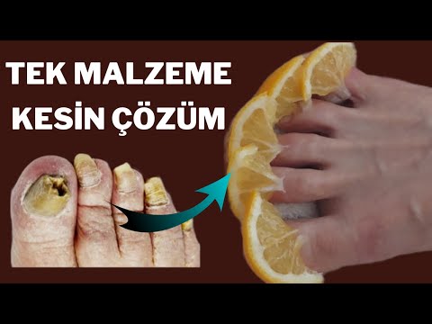 2 DOĞAL ÇÖZÜM- TEK MALZEMELİ TIRNAK MANTARI TEDAVİSİ/ EVDE NASIL YAPILIR?