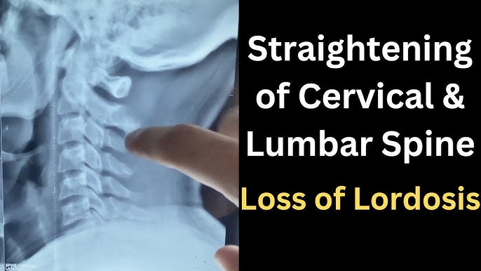 What is Straightening of Neck or Reversal of Curve Mean? - Dr Mandell 