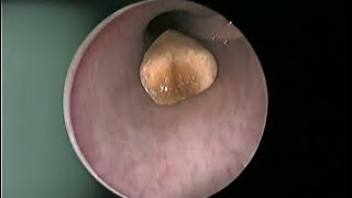Конкремент в уретре. Цистоскопия, камни в мочеиспускательном канале | Concretion in the urethra