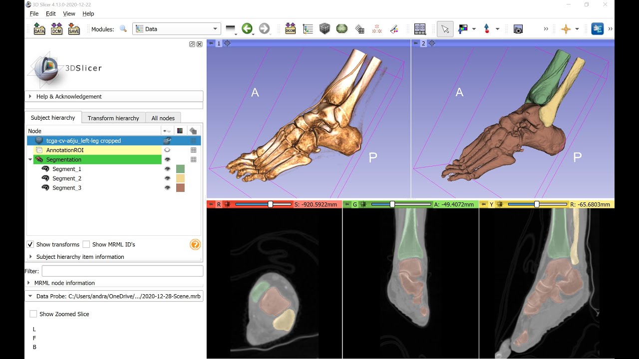 Feet segmentation in 3D Slicer