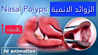 استئصال الزوائد الانفية جراحياً Nasal Polyps | الاسباب والتشخيص والعلاج ??