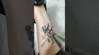 First Treatment Of Laser Tattoo Removal