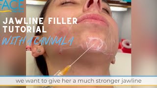 Jawline Filler and Chin Filler Cannula Tutorial