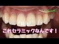 ✨前歯２本を天然歯のような仕上がりに✨（仮歯→セラミック）
