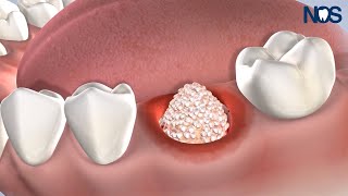 Post-Op Instructions: Bone Grafting at Naperville Oral Surgery & Dental Implants