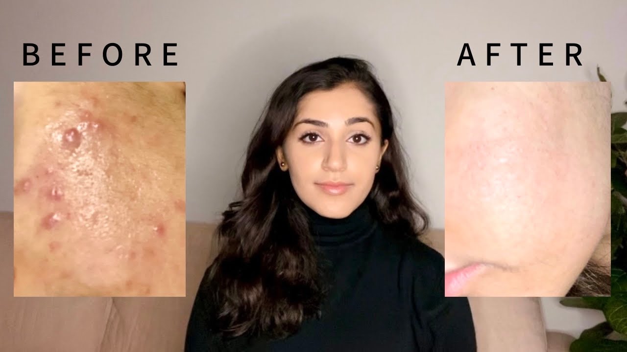My Isotretinoin (Accutane) Journey | how I cleared my hormonal acne