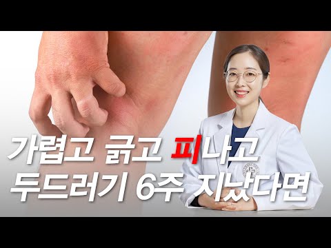 두드러기 가려움증 핵심 치료법은? | 스테로이드, 항히스타민제, 알레르기