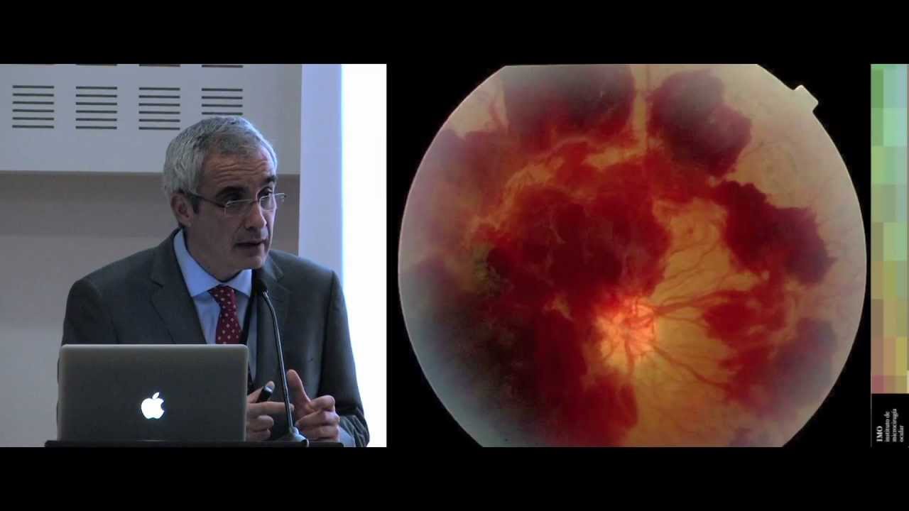 flotantes en mi ojo síntomas de diabetes