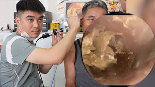 👂💤 耳かき | 耳掃除 | 2名のお客様の耳の検査 💖 DR. LAI MINH TUAN
