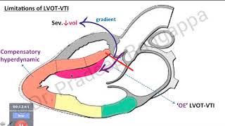 SVV is superior to VTI variability (procon debate)  | Dr. Pradeep Rangappa