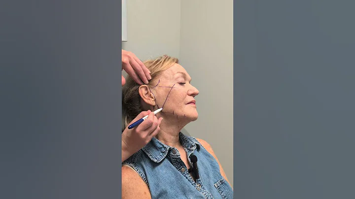 Marking for a deep plane facelift and neck lift