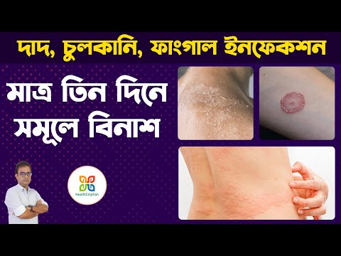 ভিডিও: কিভাবে Candida চিকিত্সা: 15 ধাপ (ছবি সহ)