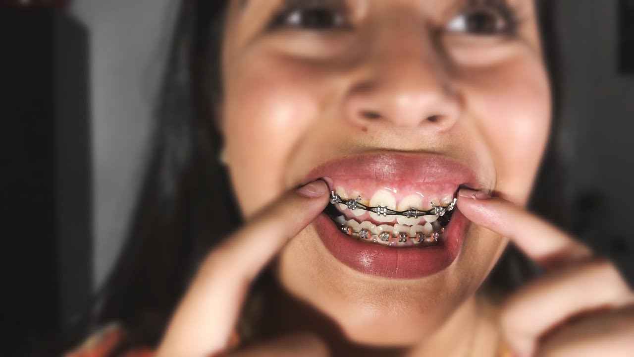 Braces Update YouTube