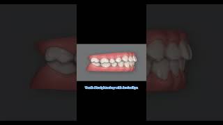 Pulling down the upper canine and improving overbite.