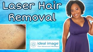 Laser Hair Removal | Ideal Image | 1st Appt Process + Results | Tiffany Arielle
