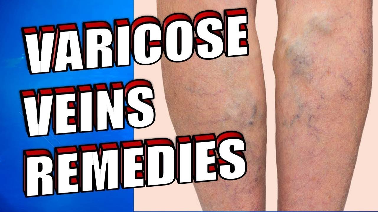 7 Natural Ways to Treat Varicose Veins at Home Easily 