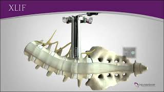XLIF Procedure (Animation)