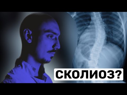 Сколиоз: что нужно знать пациенту