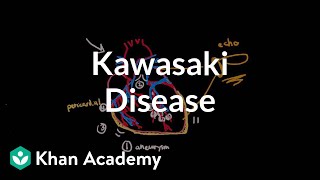 Kawasaki disease: diagnosis and treatment | Circulatory System and Disease | NCLEX-RN | Khan Academy