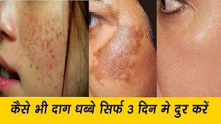 चेहरे के काले दाग-धब्बे, झाइयां, निशान, चेचक के दाग गारंटी के साथ जड़ से खत्म करो सिर्फ 3 दिन में।