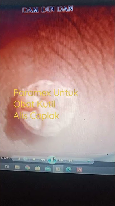 Paramex bisa buat Obat Kutil