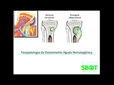 Vídeo: Diferença Entre Osteomielite E Artrite Séptica