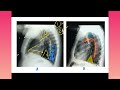 Tkrhtp 08 lateral chest xray some important points