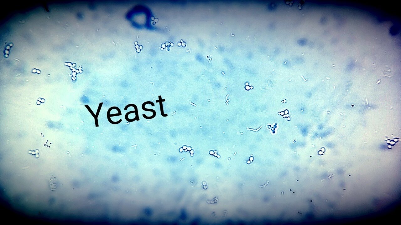 Candida Albicans Yeast in Urine Microscope & Gram Stain - YouTube