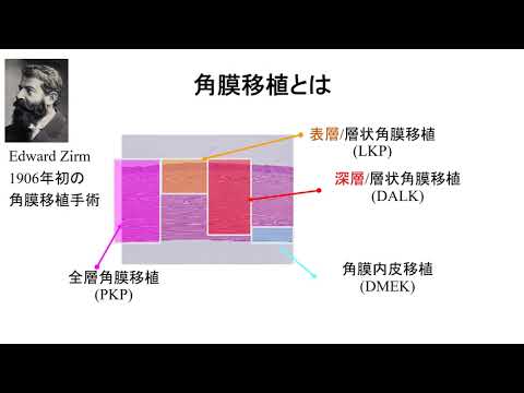 これで完璧角膜移植 : 全層角膜移植,上皮移植,DALK,DSAEKなど基本か… これで完璧角膜移植-全層角膜移植,上皮移植,DALK,DSAEKなど基本